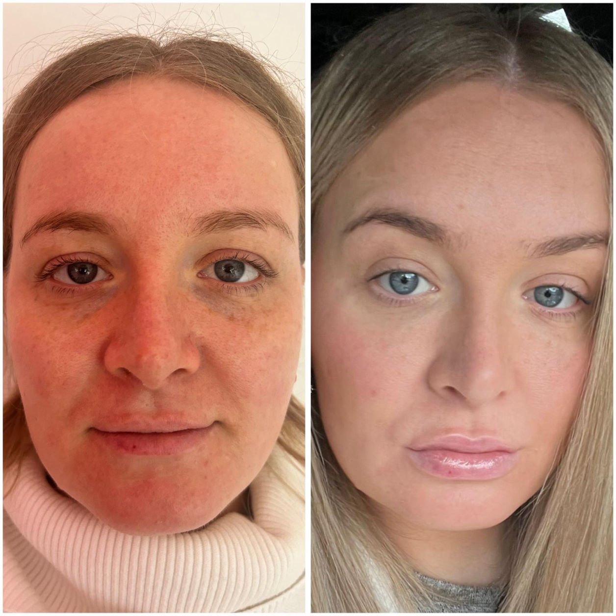 Dermal Fillers