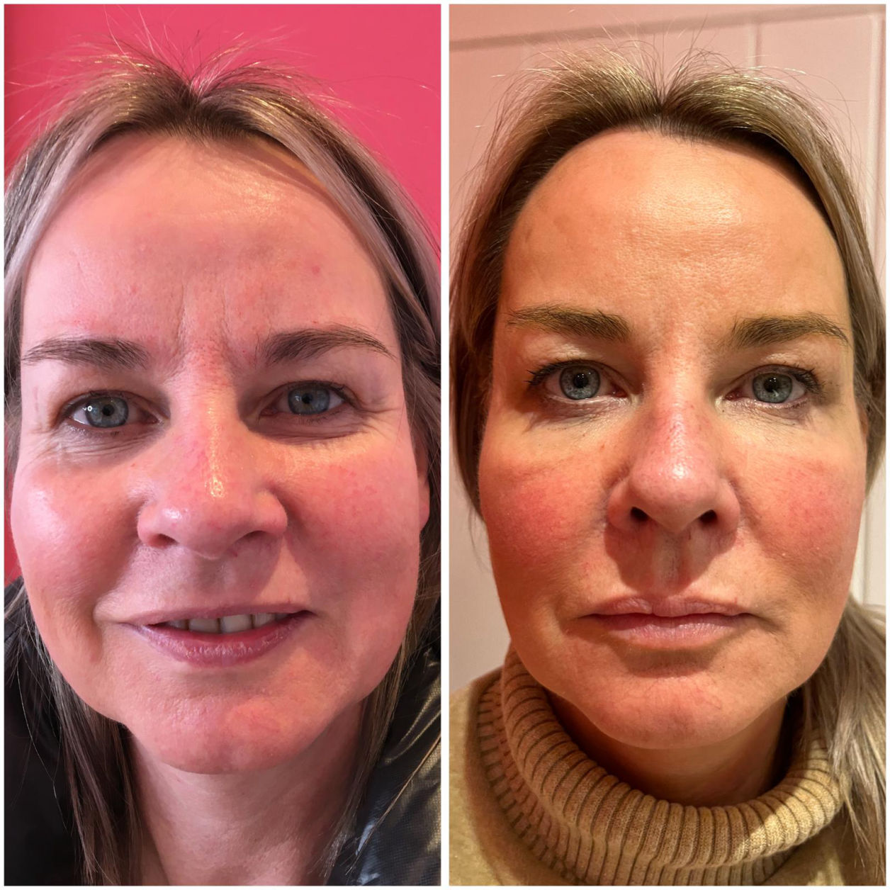 Non Surgical Facelift