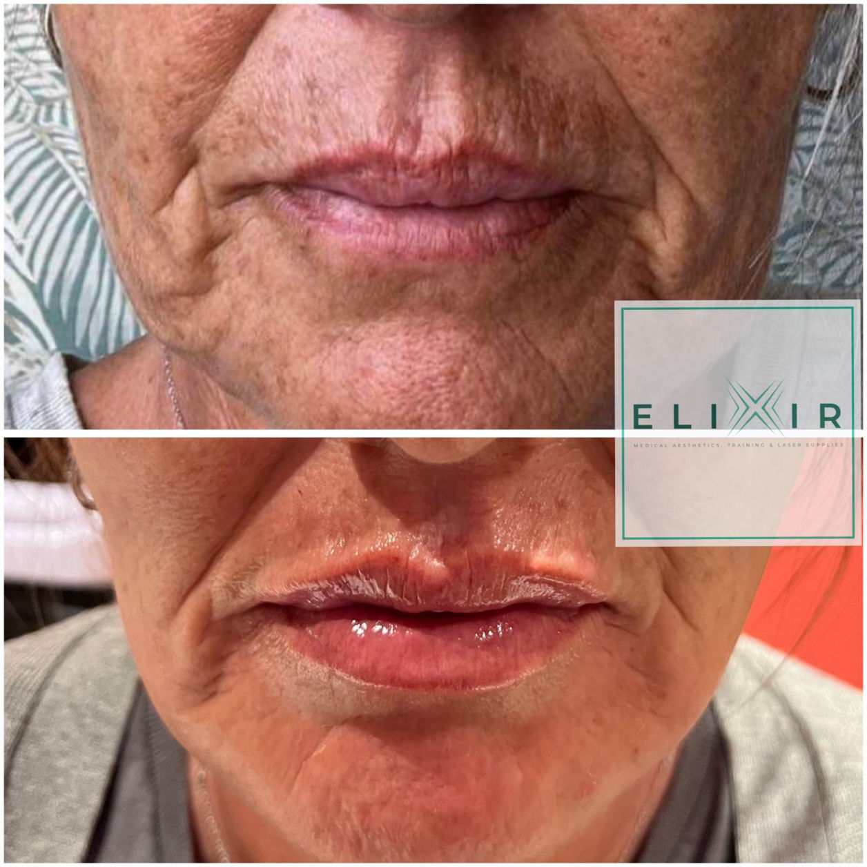 Dermal Fillers