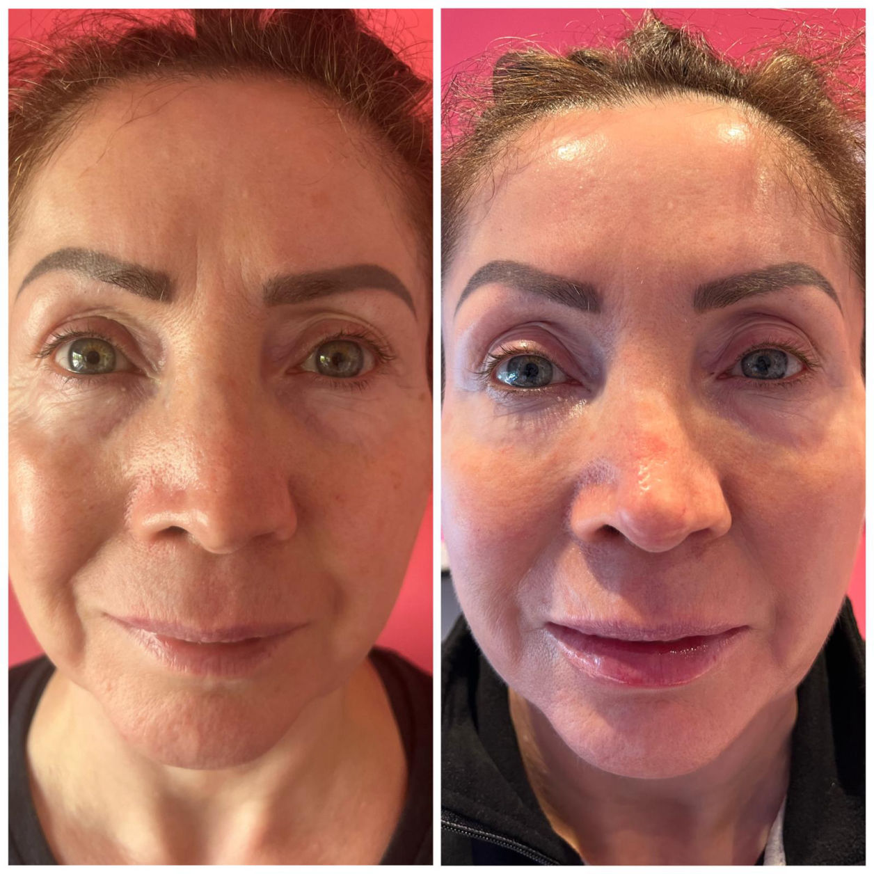 Non Surgical Facelift